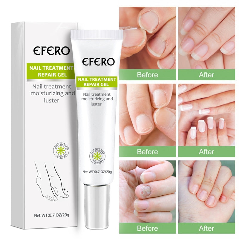 ephero | Anti-Inflammatory Fungus Elimination Cream + Gifts [PROVEN RESULT]